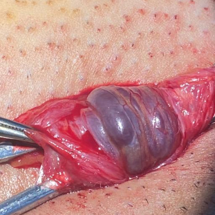 دوالي الخصية الميكروسكوبية